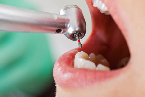 Best Urgent Care for Lost Fillings or Crowns in Fort Knox, KY